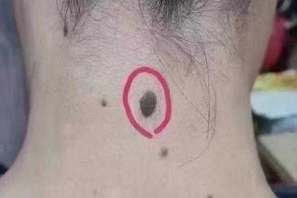 风水上女生脖子后面有痣代表什么啊