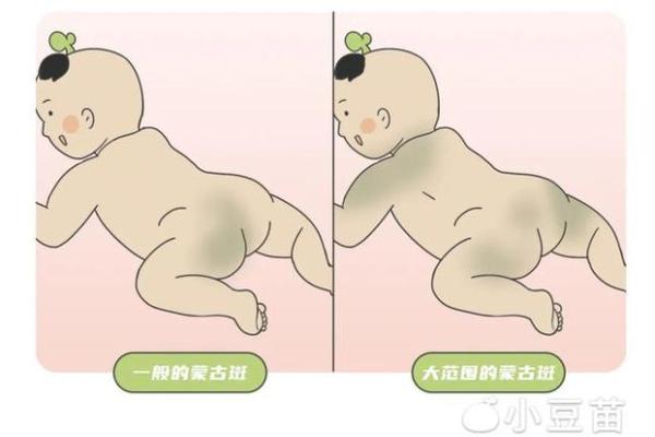 屁股有胎记算命分析