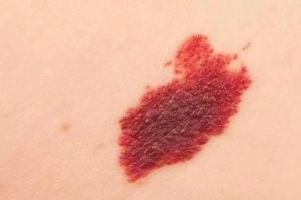 风水胎记胎记是红色的好吗危害
